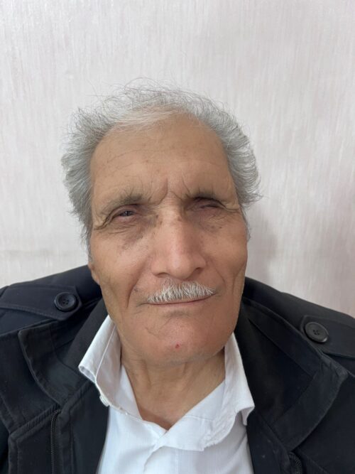 قبل از استفاده پروتز چشم