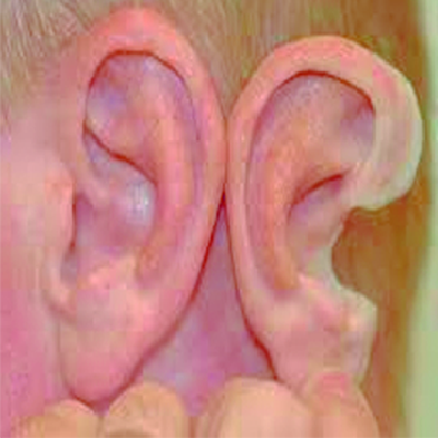 پروتز گوش